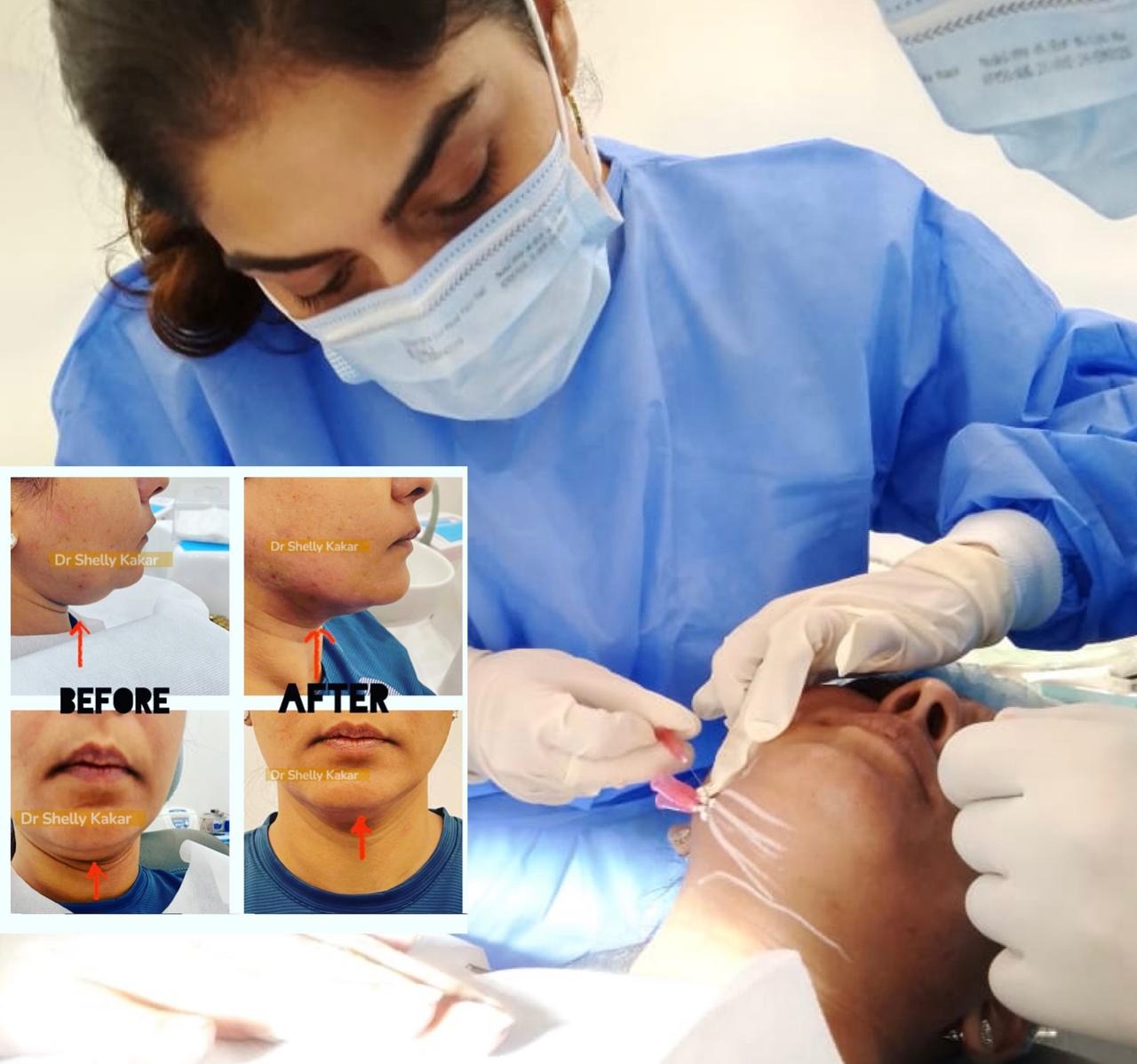 Facial/Lip Enhancement / Augmentation with Fillers - Thread (Face) Lift (Non Surgical) clinical image 2