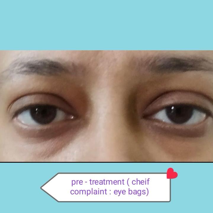 PRF for Skin Rejuvenation, Dark Circles, Hyperpigmentation, Hand & Neck, PRP + Growth Factors Therapy, Exosomes, Microneedling clinical image 2